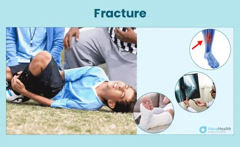Fracture: Symptoms, Causes, and Treatment