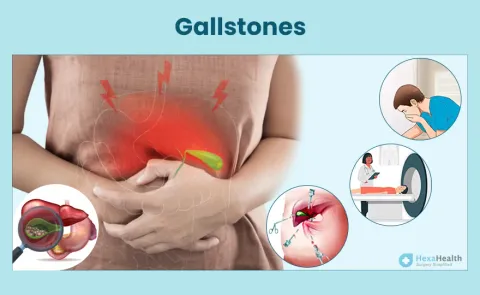 Gallbladder Stones: Symptoms, Causes, and Treatment