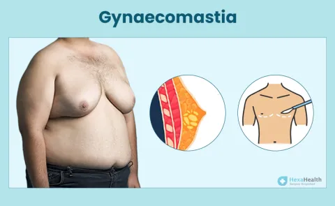 Gynaecomastia: Symptoms, Causes, and Treatment