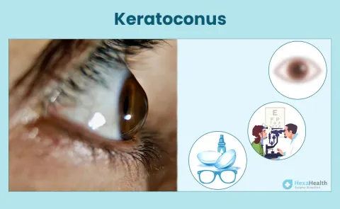 Keratoconus: Symptoms, Causes, and Treatment