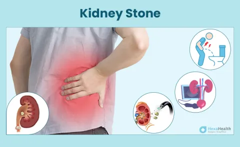 Kidney Stones: Symptoms, Causes, and Treatment