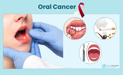 Oral Cancer: Symptoms, Causes, and Treatment