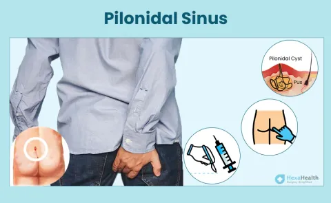 Pilonidal Sinus: Symptoms, Causes, and Treatment