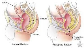 Rectal Prolapse: Symptoms, Causes, and Treatment