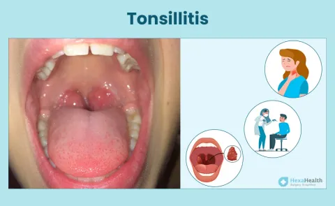 Tonsilitis: Symptoms, Causes, and Treatment