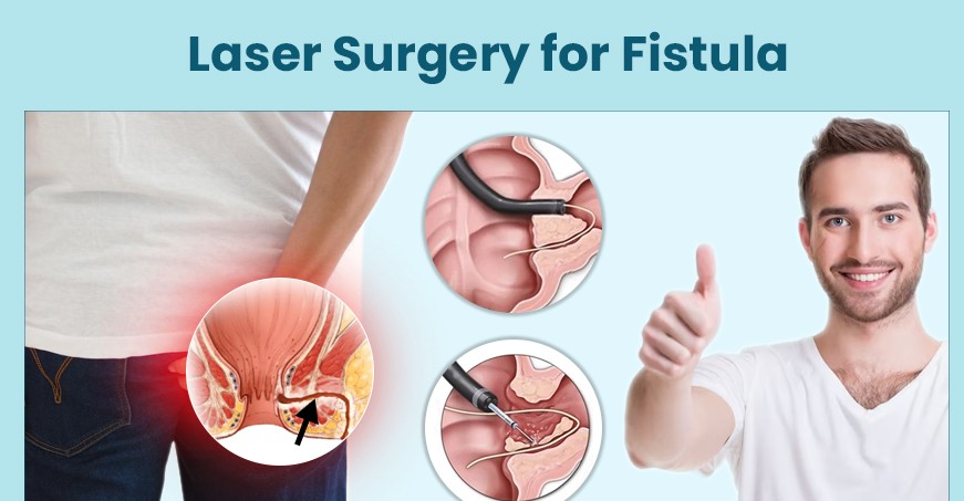 Laser Surgery for Fistula - Procedure, Benefits, Recovery