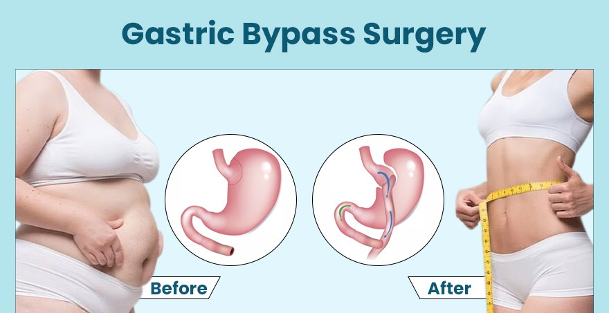 Gastric Bypass Surgery: Overview, Benefits, and Recovery
