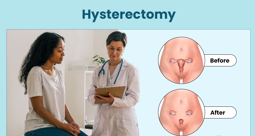 Hysterectomy: Procedure, Benefits, Side Effects, Recovery
