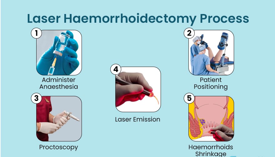 Laser Haemorrhoidectomy Process
