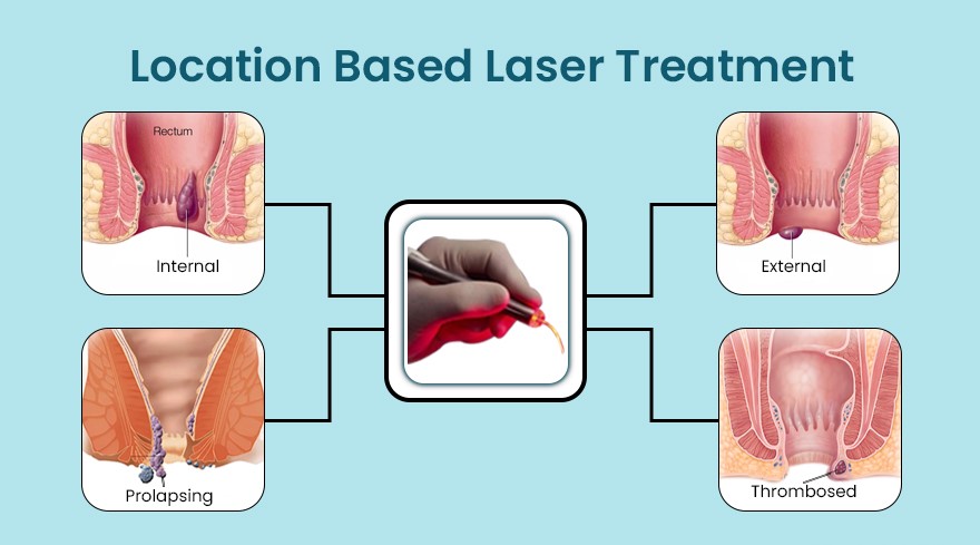 Location Based Laser Treatment