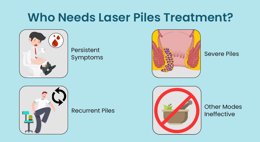 Who Needs Laser Piles Treatment?