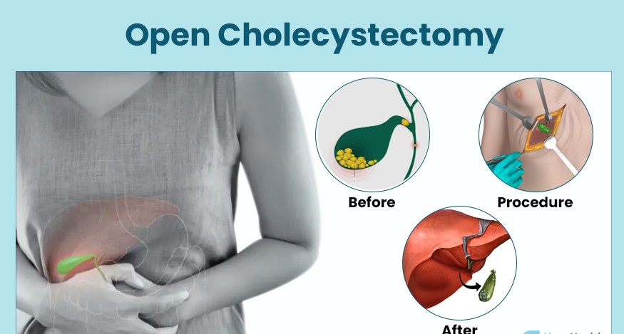 Laparoscopic Cholecystectomy: Procedure Steps, Recovery