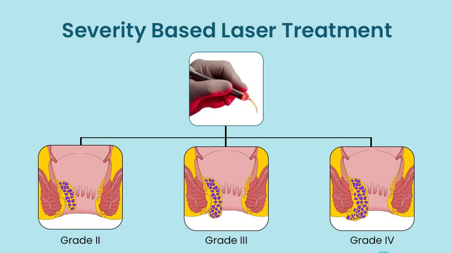 Severity Based Laser Treatment