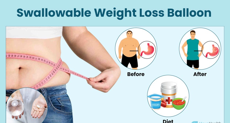 Endoscopic Intragastric Balloon: Overview, Benefits, and Recovery